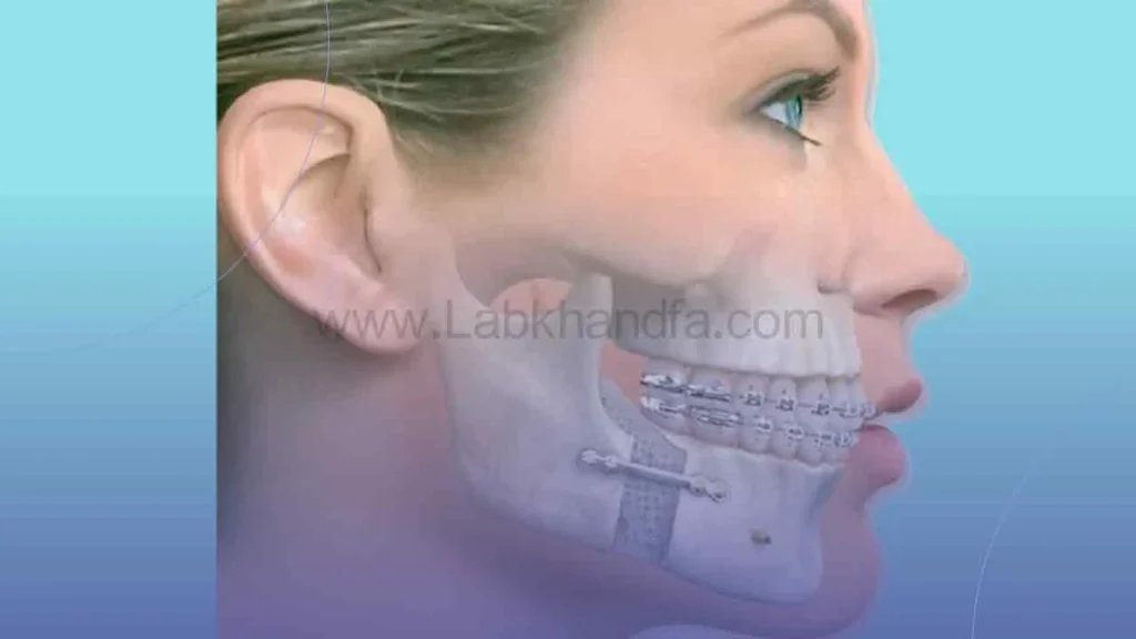 جراحی بازسازی فک