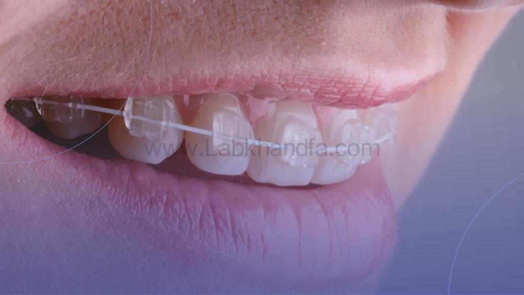 ارتودنسی سرامیکی دندان