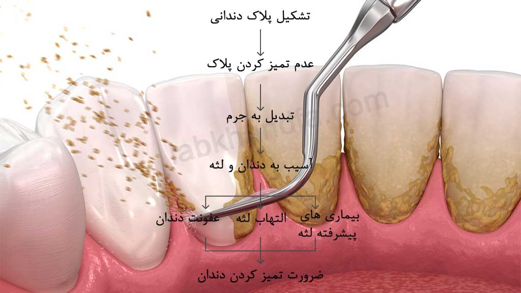 اهمیت جرم گیری دندان