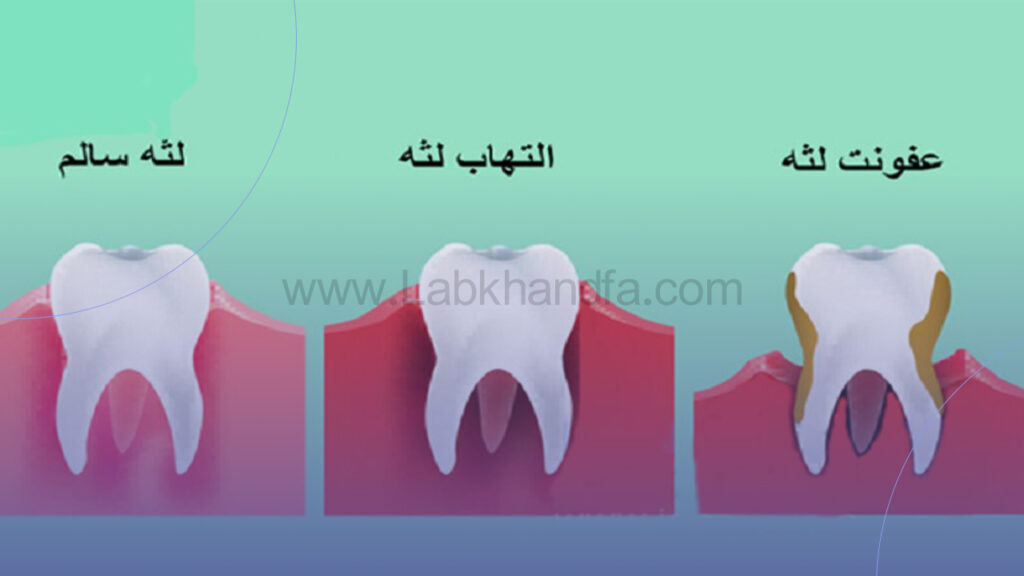 بیماری های لثه