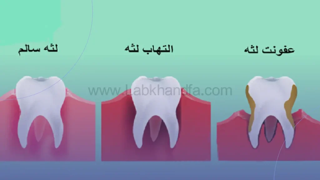 انواع بیماری لثه