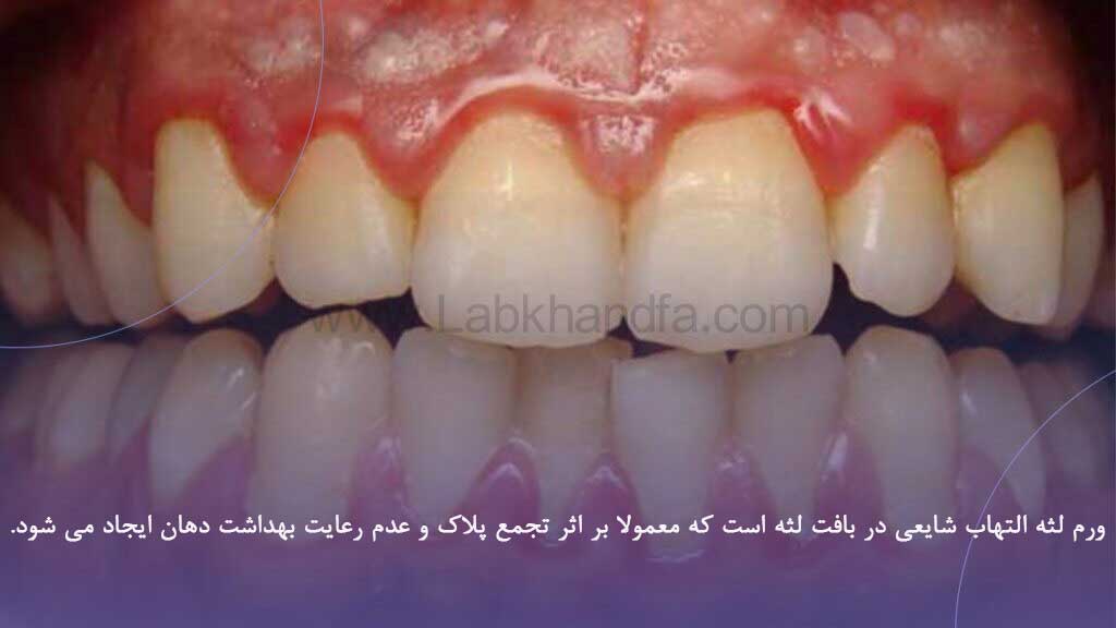 ورم لثه 