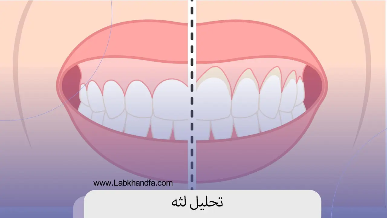 تحلیل لثه