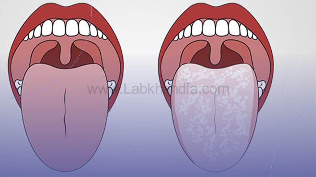 برفک دهان چیست؟