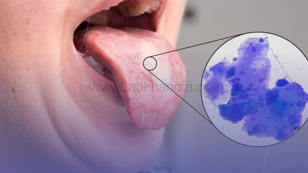 علائم برفک دهان