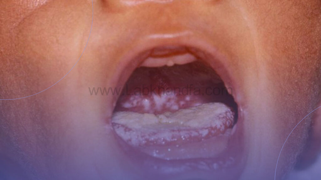 عکس برفک دهان نوزاد