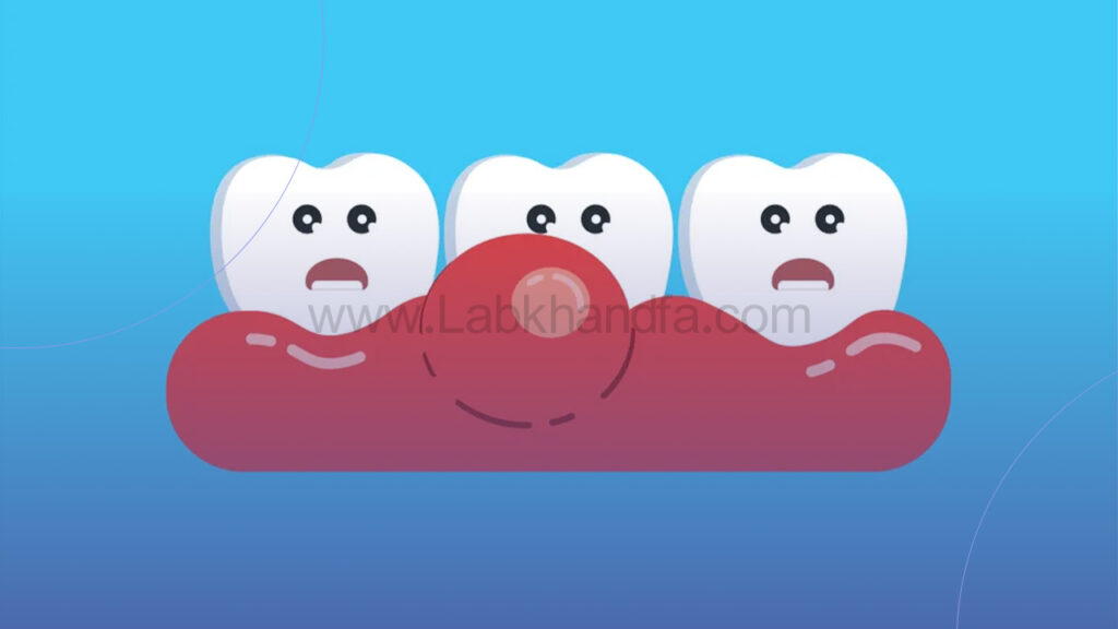 نشانه ورم لثه