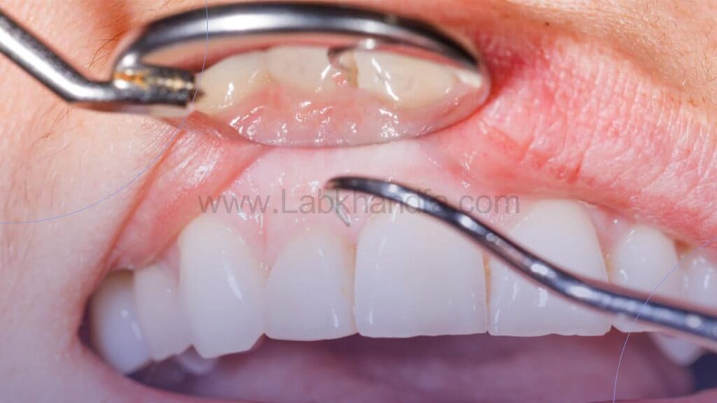 جراحی لثه با تیغ