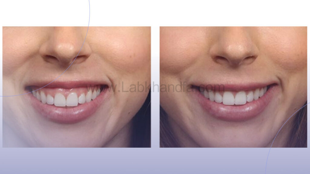 عکس عمل زیبایی لثه