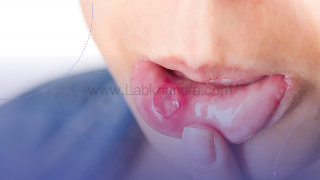 محل آفت دهان معمولا در داخل لب ها یا گونه است 