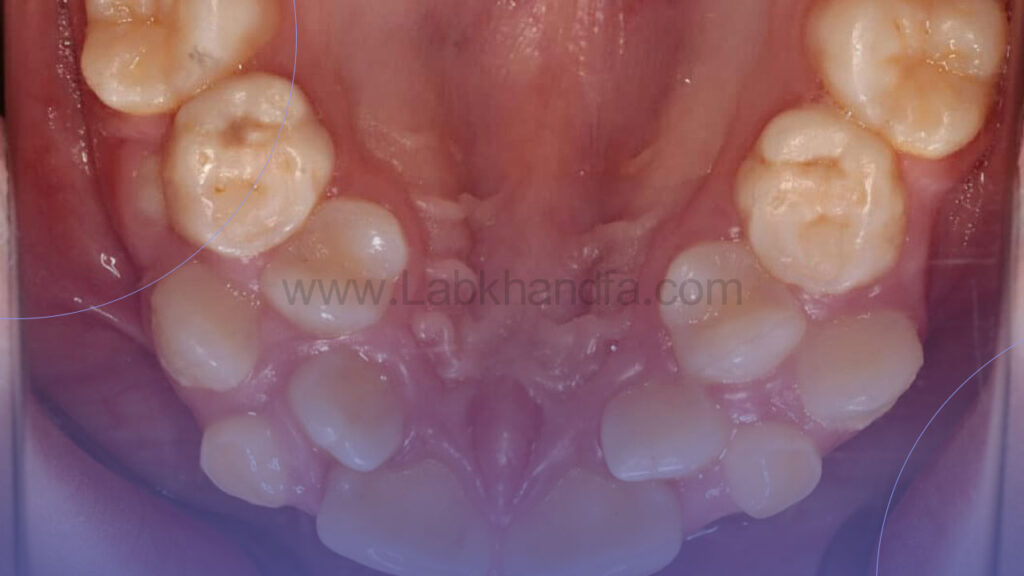 به هم ریختگی شدید دندان ها توسط لیست بهترین متخصص ارتودنسی در تهران برطرف می شود