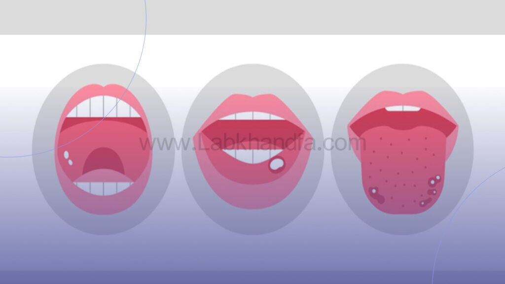 تفاوت محل آفت دهان با زگیل دهانی