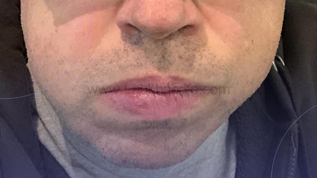 تورم و التهاب از عوارض لیفت لثه