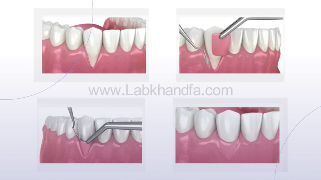 جراحی بازسازی بافت لثه