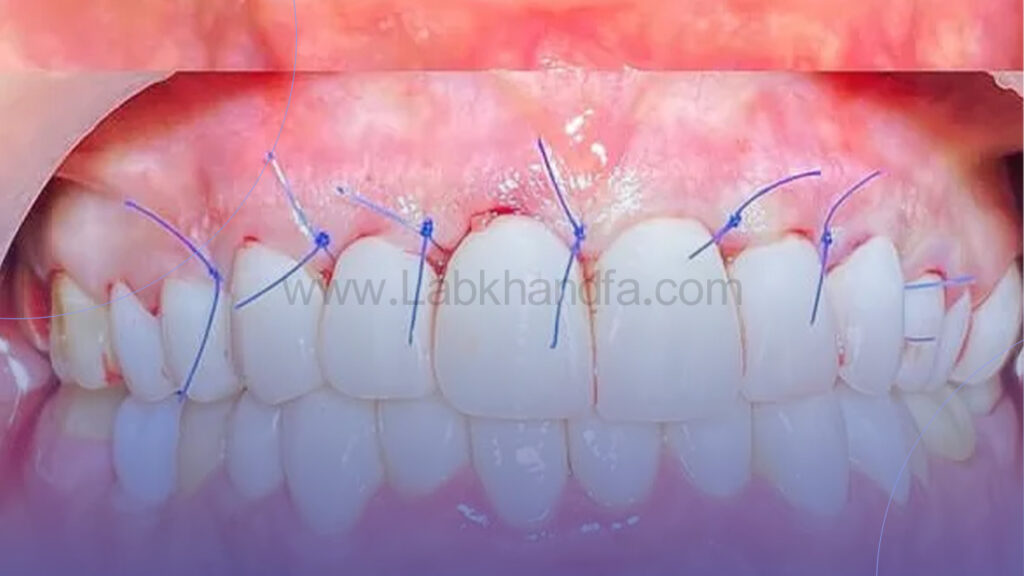 جراحی سنتی لثه