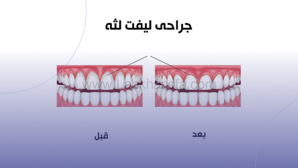 جراحی لیفت لثه