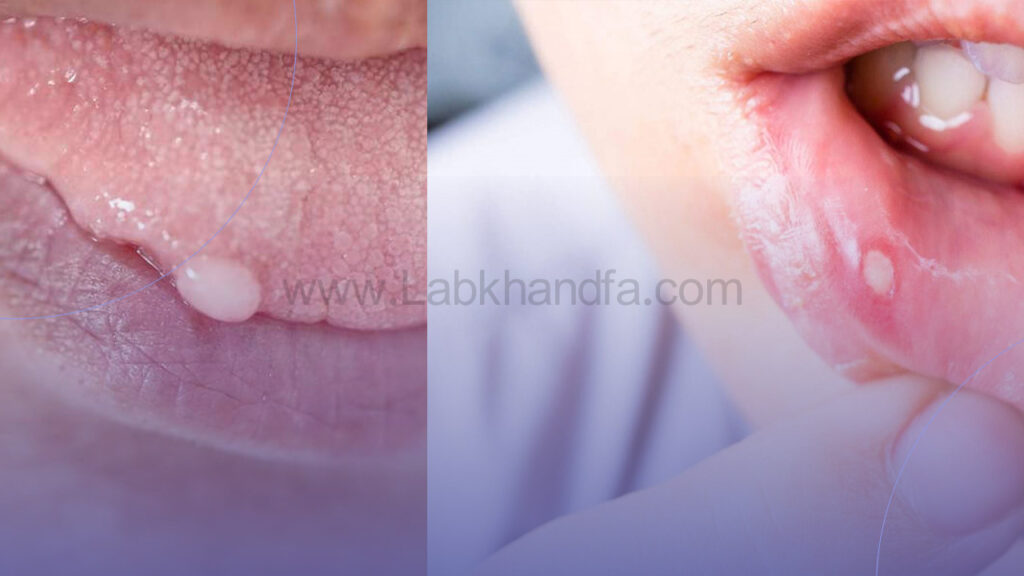 تفاوت ظاهری زگیل دهانی و آفت دهانی 