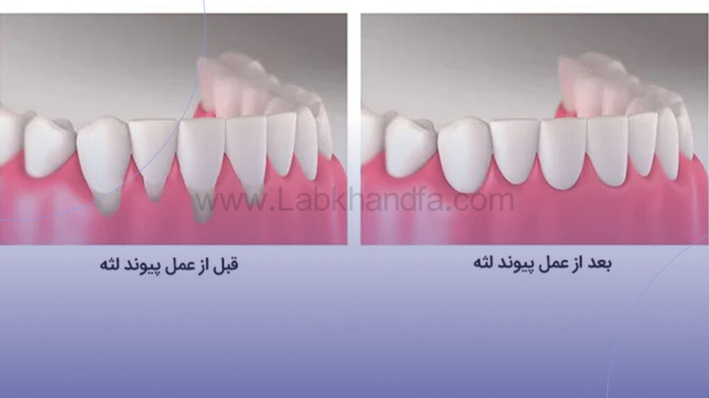 عمل پیوند لثه