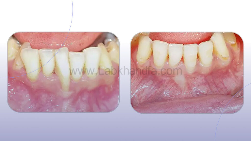 عکس قبل و بعد جراحی لثه