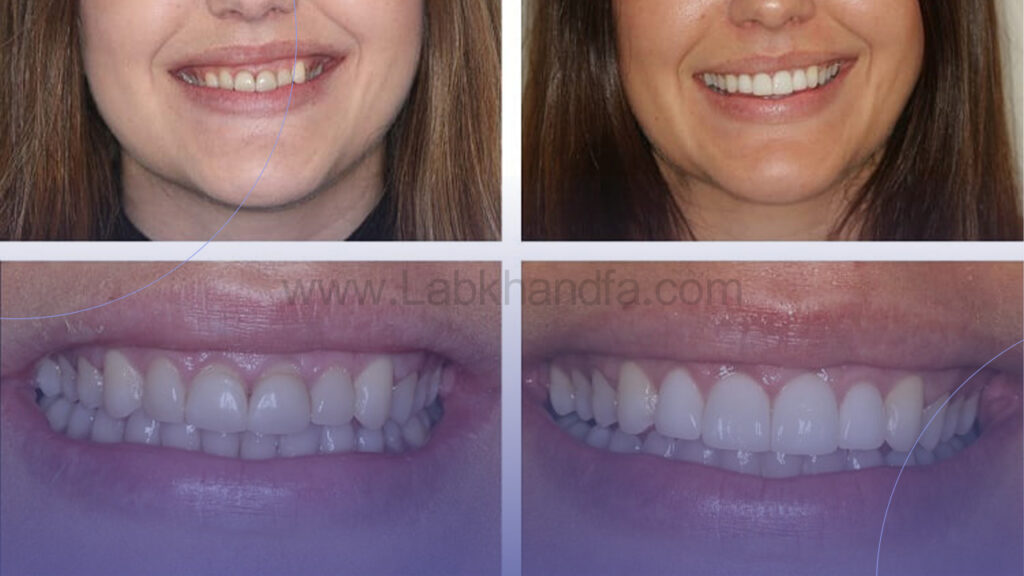 عکس قبل و بعد لیفت لثه