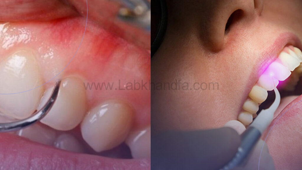 لیفت لثه با تیغ و لیزر