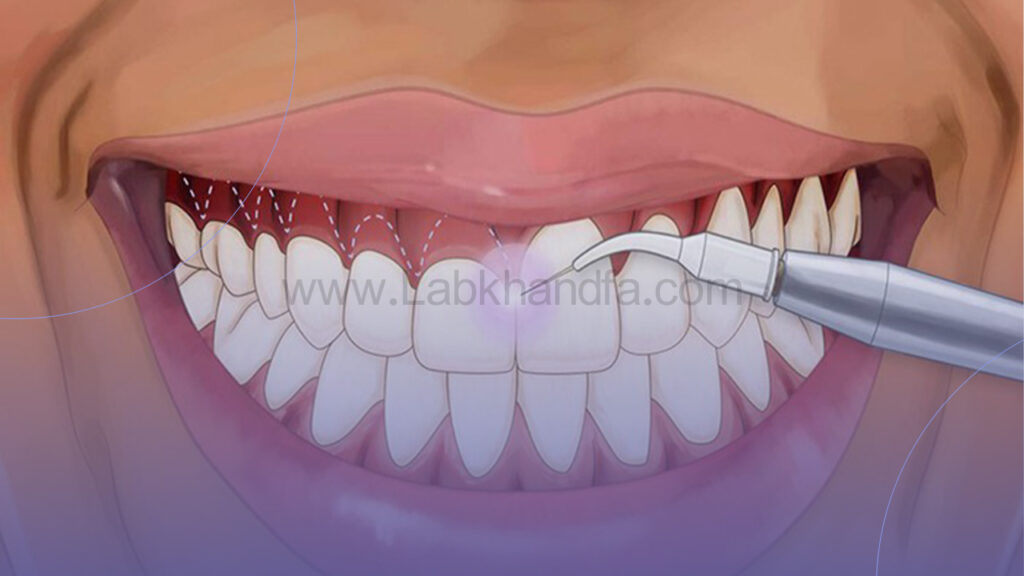 عکسی از روش لیفت لثه