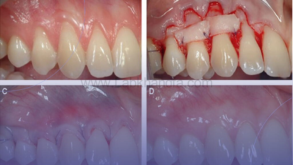 عکسی از بافت های التیام یافته لثه دندان بعد از جراحی لثه