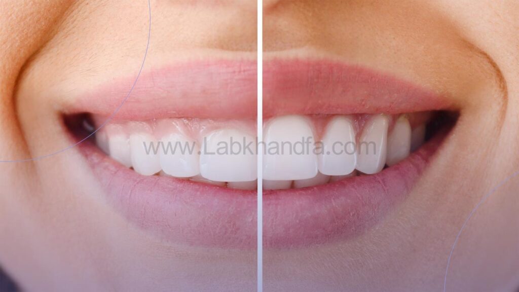 نامتقارنی خط لثه