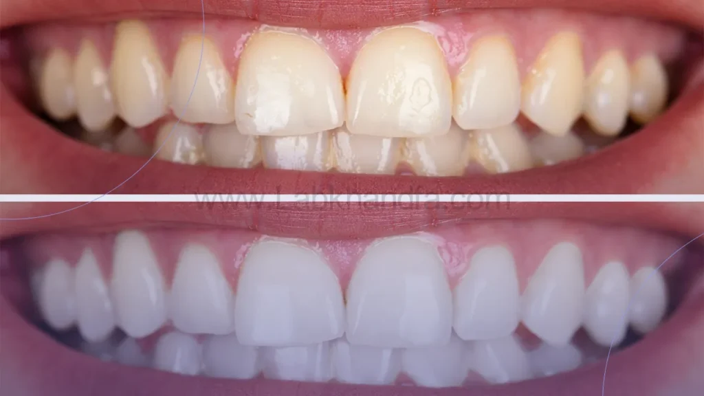 عکسی از قبل و بعد لمینت دندان