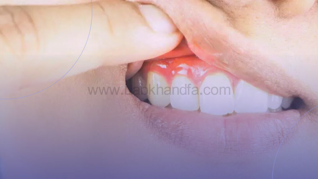 علائم عفونت لثه ها در کودکان