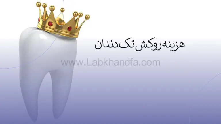 هزینه روکش تک دندان
