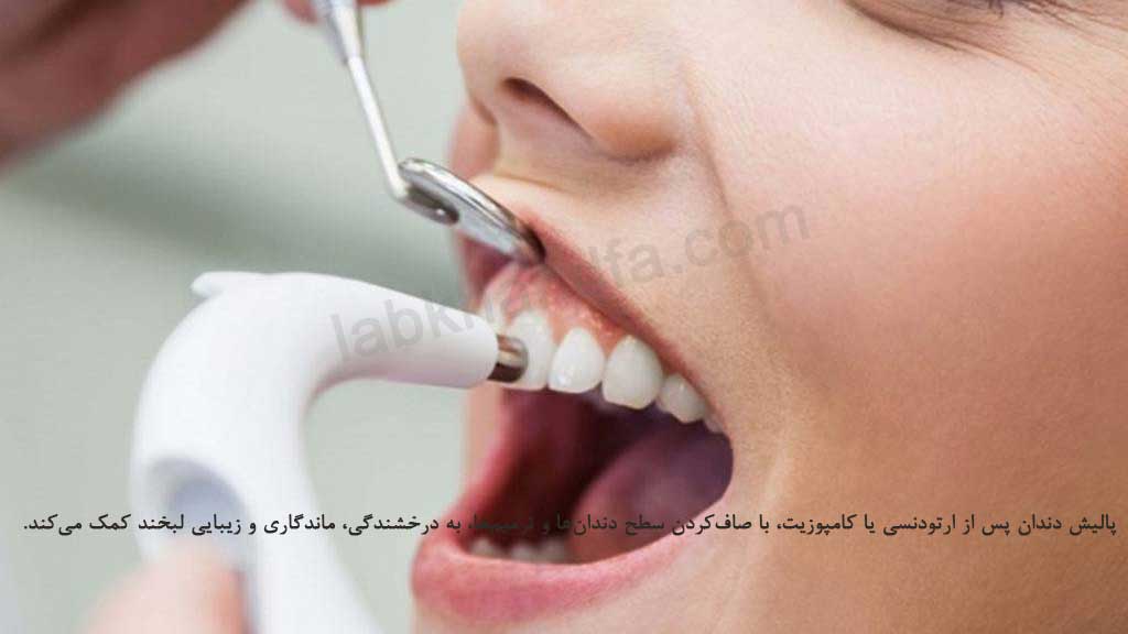 پالیش دندان بعد از ارتودنسی و کامپوزیت
