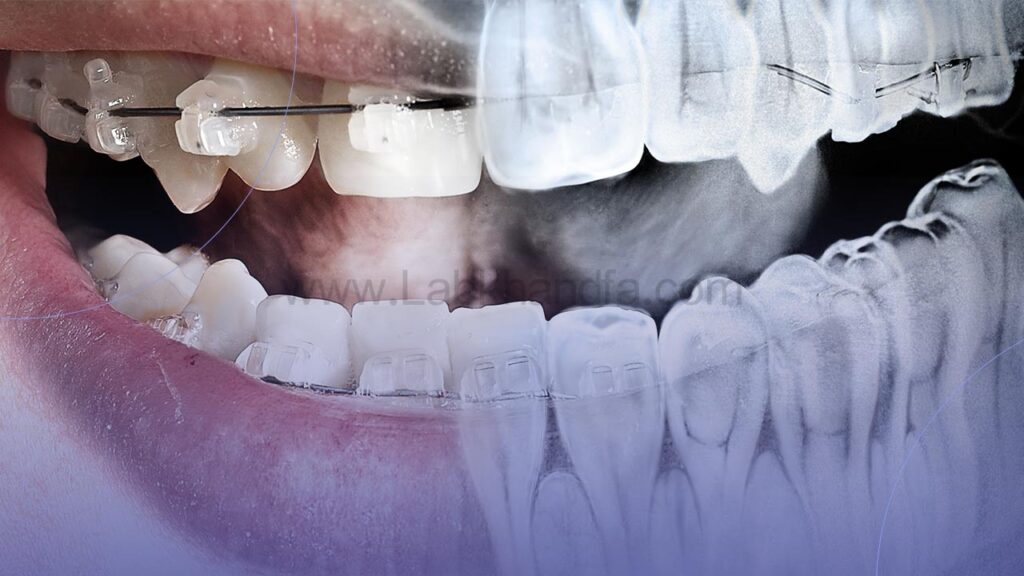 عکس دندان برای ارتودنسی