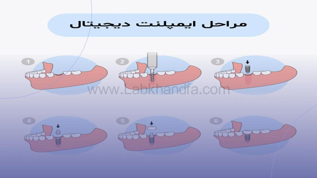 مراحل ایمپلنت دیجیتال