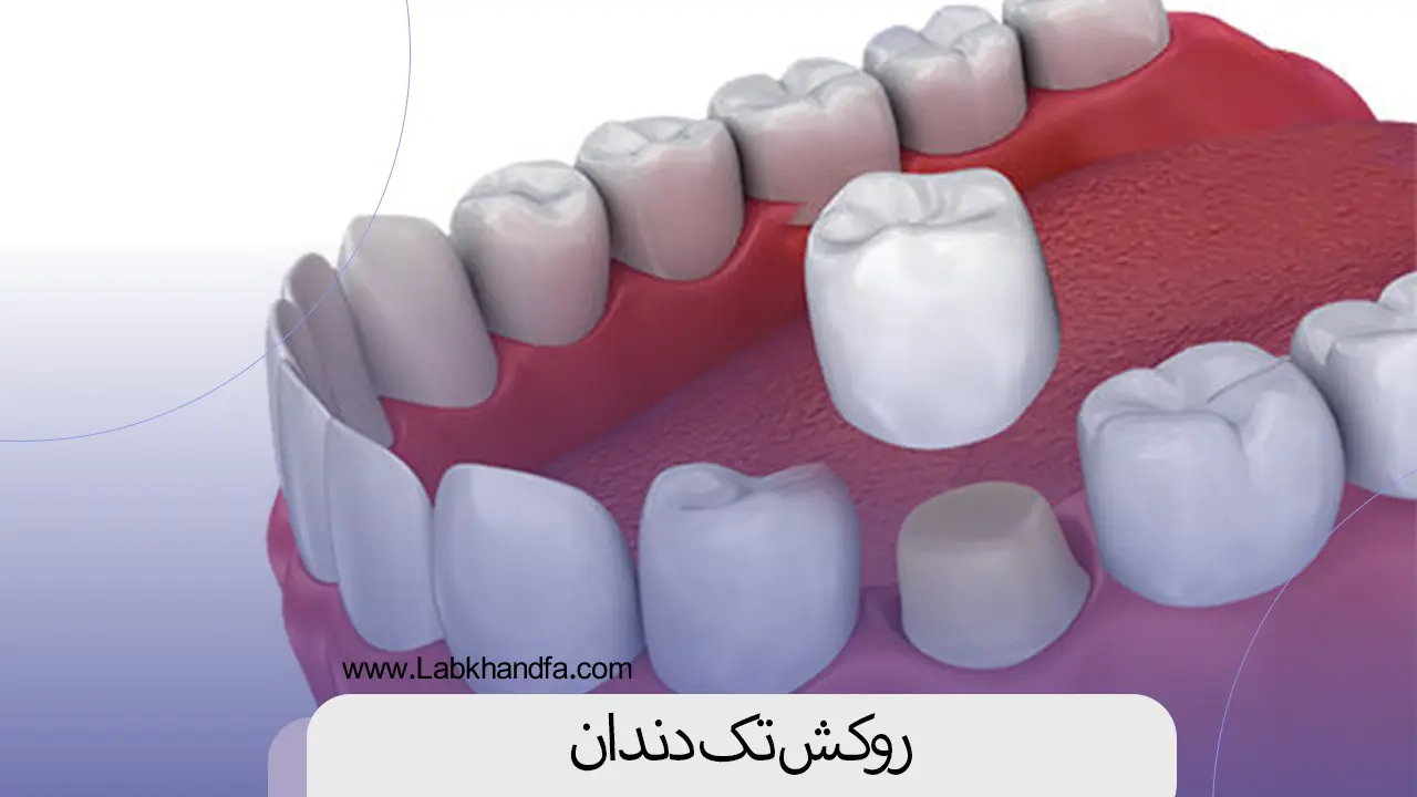 روکش تک دندان
