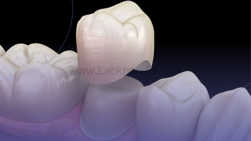 روکش تک دندان