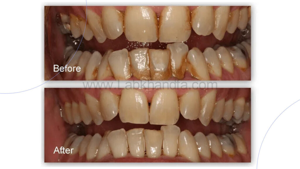 تصویر بروساژ دندان قبل و بعد