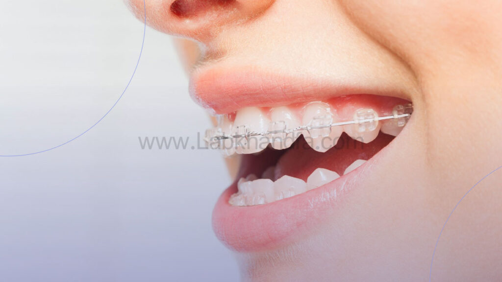 بریش شفاف ارتودنسی دیمون