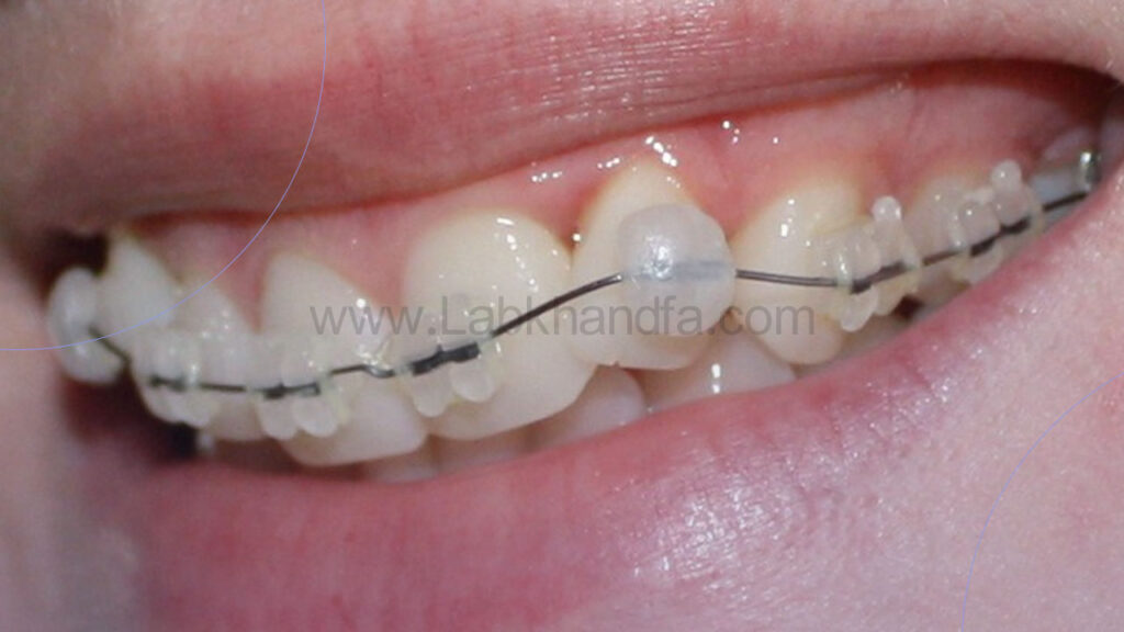 عکس از نحوه قرارگیری موم ارتودنسی بر روی براکت