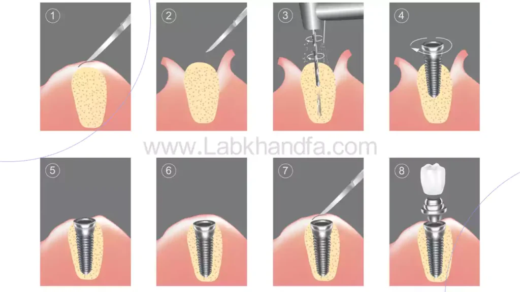 مراحل ایمپلنت دندان تصویری