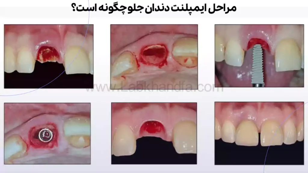 مراحل ایمپلنت دندان جلو
