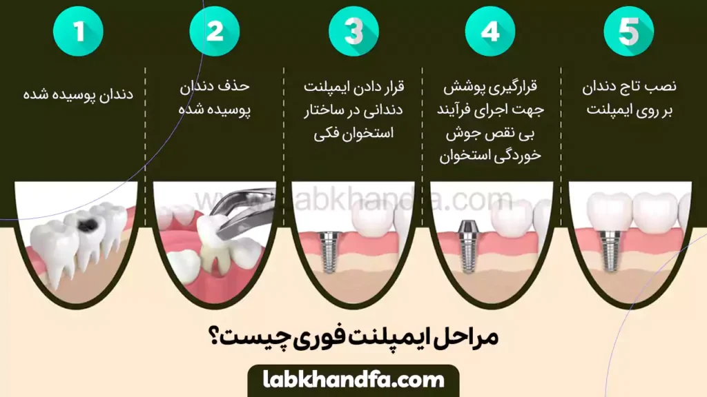 مراحل ایمپلنت فوری چیست؟