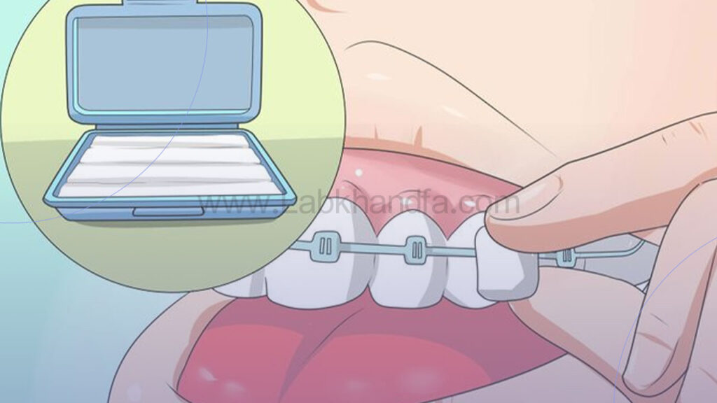نحوه گذاشتن موم ارتودنسی