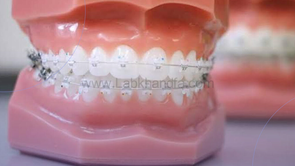 نصب براکت های دیمونچ در ارتودنسی دیمون