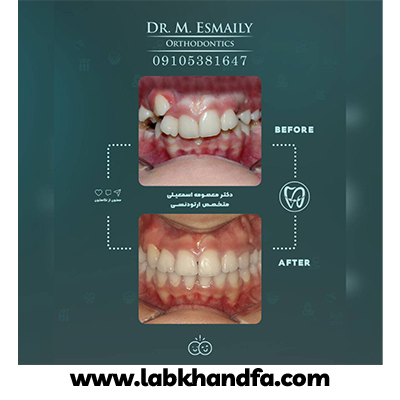 نمونه کار ارتودنسی دکتر معصومه اسماعیلی