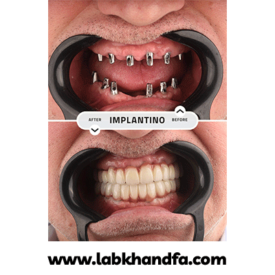 نمونه کار ایمپلنت دکتر شیرین شیدفر