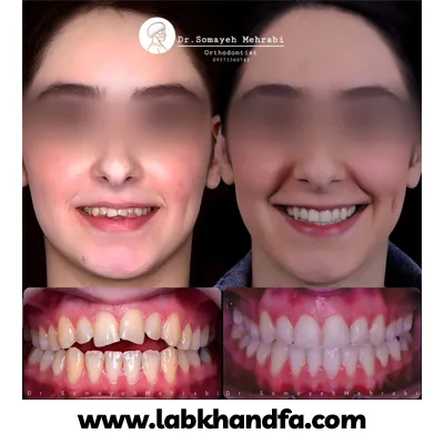 یکی دیگر از نمونه کارهای ارتودنسی دکتر سمیه مهرابی