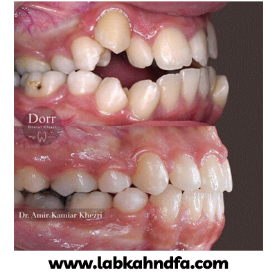 نمونه کار ارتودنسی دکتر هادی درویش پور شماره 2