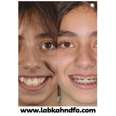 نمونه کار ارتودنسی دکتر محمد فراهانی شماره 2