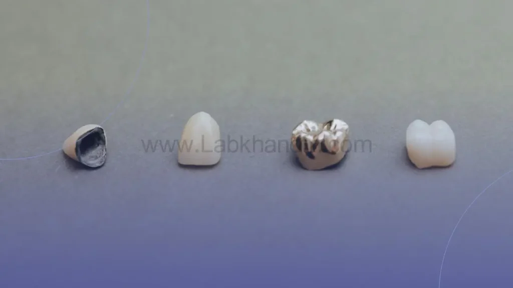 انواع روکش دندان